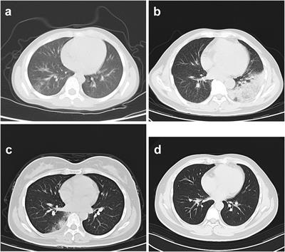 Case Report: Metagenomic next-generation sequencing applied in diagnosing psittacosis caused by Chlamydia psittaci infection